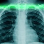 ZABRINJAVAJUĆE! Rentgentski snimci pokazuju javljanje simptoma raka dojke kod vakcinisanih žena