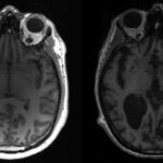 VLAST ZATAŠKAVA PODATKE?! MLADI KANAĐANI NA UDARU BIZARNE NEUROLOŠKA BOLEST
