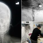 LUDNICA! Samozvani iscelitelj zakucao ženi ekser u glavu tvrdeći da će tako roditi dečaka