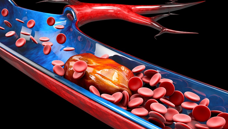  Svi su u opasnosti od krvnih ugrušaka!? CDC i Pfizer izdaju hitna upozorenja o krvnim ugrušcima čak i kod najzdravijih sportista
