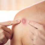 BATUT uskoro dostavlja lekarima uputstvo kako da prepoznaju majmunske boginje