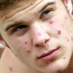 Britanski zdravstveni stručnjaci upozoravaju: Majmunske boginje se najviše pojavljuju kod HOMOSEKSUALACA