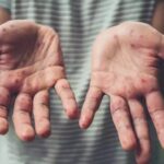 Ko njima još veruje? SZO o majmunskim boginjama i masovnoj vakcinaciji