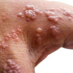 SZO TVRDI da je epicentar majmunskih boginja u EVROPI