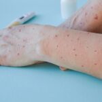 Britanski zaničnici: Oni koji boluju od MAJMUNSKIH BOGINJA da se uzdrže od seksa