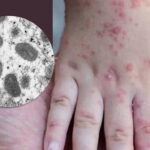 Britanci od danas oštrije formulišu MAJMUNSKE BOGINJE: "Bolest koju treba prijaviti"