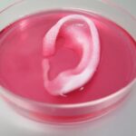 Po prvi put USPEŠNO obavljena transplantacija UHA ŠTAMPANOG 3D ŠTAMPAČEM