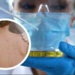 Epidemija majmunskih boginja može trajati mesecima, moguće nove mutacije