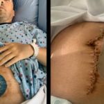 Svedočenje čoveka koji je izgubio 2 metra creva zbog vakcinacije protiv COVID-a: "Bio sam zdrav kada sam se vakcinisao" (FOTO)