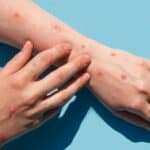 Moguće zaustavljanje MAJMUNSKIH BOGINJA U EVROPI kako tvrdi SZO!