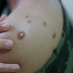 BROJ slučajeva majmunskih boginja širom sveta prešao 50.000