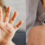 Zarazili je "roditelji"?! Četvorogodišnja devojčica u Nemačkoj zaražena majmunskim boginjama