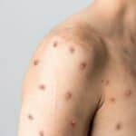 Nova statistika SZO: Više od 35.000 slučajeva majmunskih u svetu