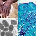 Širi se majmunska panika- Prvi smrtni slučaj Majmunskih boginja prijavljen u Indiji