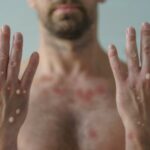 Batut: U Srbiji 23 muškarca obolela od MAJMUNSKIH BOGINJA