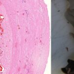 Studija: 'Nepobitni dokaz' da mRNA vakcine uzrokuju oštećenje krvnih sudova i organa