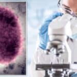 U Srbiji majmunske boginje potvrđene kod 40 muškaraca, najviše obolelih u Beogradu