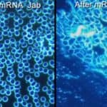 Studija koja koristi mikroskopsku analizu tamnog polja pokazuje abnormalnosti u krvi vakcinisanih pacijenata