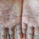 SRAMOTA! U Kliničkom centru Kragujevca pojavila se ŠUGA- "Odgovorni" prebacuju krivicu na pacijente