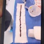 ČUDOVIŠTE! Lekari izvadili krvni ugrušak dugačak 25 cm iz VAKCINISANOG PACIJENTA (Foto)