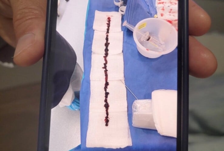  ČUDOVIŠTE! Lekari izvadili krvni ugrušak dugačak 25 cm iz VAKCINISANOG PACIJENTA (Foto)