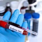 Dokazi postojanja ugrušaka posle vakcinacije: Šta je D-dimer