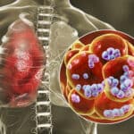 Naučnici upozoravaju da klimatske promene razvijaju smrtonosne infekcije pluća kod ljudi