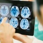 CDC istražuje porast misteriozne bolesti mozga kod potpuno vakcinisane dece