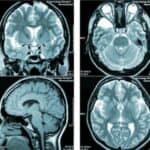 Povrede mozga nakon vakcinacije protiv COVID-a