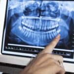 Zubari upozoravaju: Neobjašnjiv bol, gubitak zuba i problem sa kostima povezani sa vakcinom protiv Covida