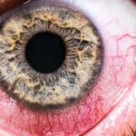 Nova studija otkriva povezanost VAKCINA protiv COVID-a sa neizlečivim krvnim ugrušcima u OKU