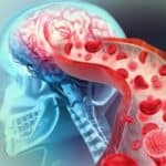 Rizik od moždanog udara naglo raste sa infekcijom COVID-19 nakon vakcinacije