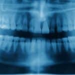 Britanci moraju sami sebi da vade zube kleštima jer ne mogu da prište stomatologa