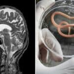 U vakcinisanoj Australiji hirurzi izvadili crva dugog 8 centimetara iz mozga žene