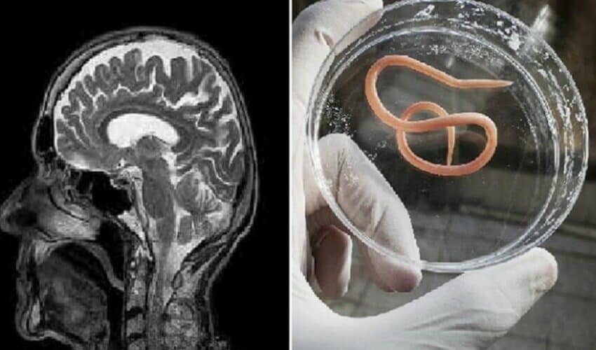  U vakcinisanoj Australiji hirurzi izvadili crva dugog 8 centimetara iz mozga žene