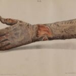 Uzbuna u SAD zbog LEPRE! Bolest o kojoj se priča u Bibliji pojavila se na Floridi