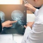 Fatalni kraniofacijalni rak 5 meseci nakon vakcinacije protiv COVID-19