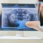 Lekari upozoravaju milione pacijenata koji doživljavaju „gubitak kostiju“ godinu dana nakon vakcinacije