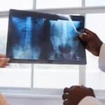 Lekari upozoravaju da potpuno vakcinisani počinju da razvijaju artritis