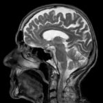 Sve nakon masovne vakcinacije protiv COVID-a! Poremećaji nervnog sistema postali glavni uzrok bolesti i smrti!