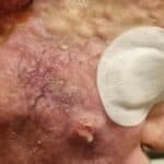 Slučajevi turbo raka od Covid vakcina su preplavili društvene mreže