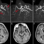 Studija: Injekcije protiv Covid-a mogu izazvati glavobolju koja se pretvara u napade koji dovode do smrti
