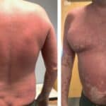 Vakcine protiv Covid-a mogu dovesti do ozbiljnih bolesti kože