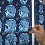 Pandemijski stres smanjio mozak beba