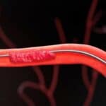 Vrhunski kardiolog: Vakcine protiv Covid-a izazvale su porast od 112.000% ugrušaka u mozgu