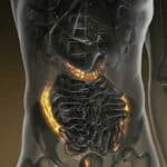 Turbo rak debelog creva porastao za 500% među vakcinisanima protiv kovida