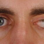 Objavljena je nova studija: Vakcinisane protiv COVID-a mogu da dovedu do ozbiljnih očnih problema