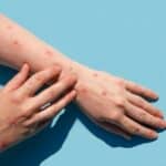 Počinje ludnica! Švedska i Španija prijavile prve slučajeve MAJMUNSKIH BOGINJA ni par sati nakon što je SZO proglasio vanrednu situaciju (VIDEO)