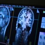 Studija: Porast Alchajmerove bolesti je izazvan Covid vakcinama