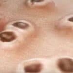 Vrhunski virusolozi upozoravaju: Majmunske boginje su zapravo „autoimuna bolest“ izazvana vakcinom protiv COVID-a